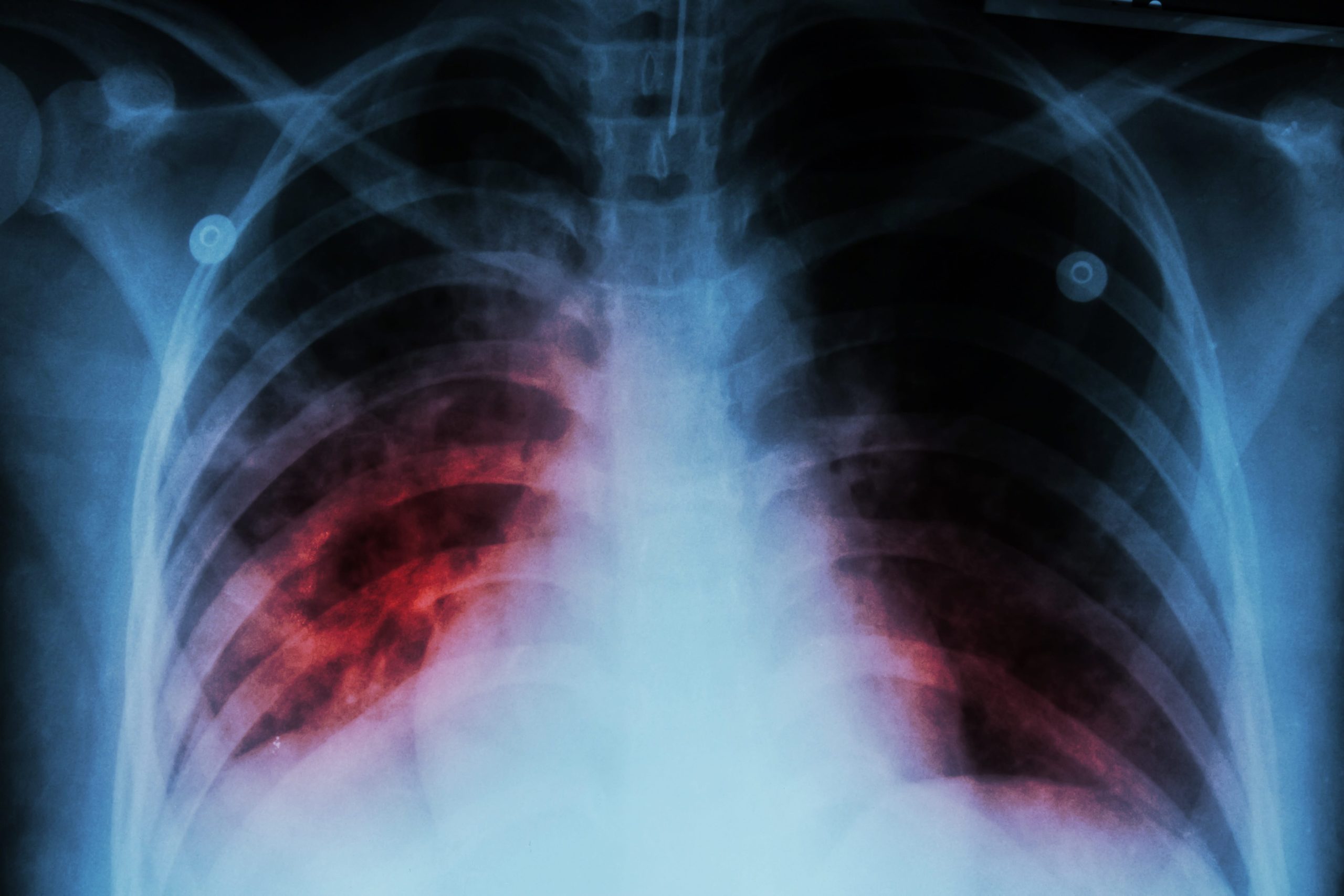 X-ray of chest